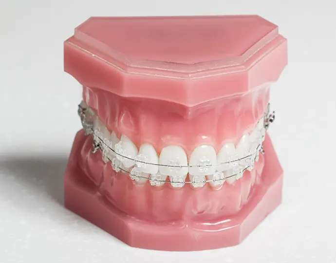 難症例でも対応できるワイヤーブラケット矯正