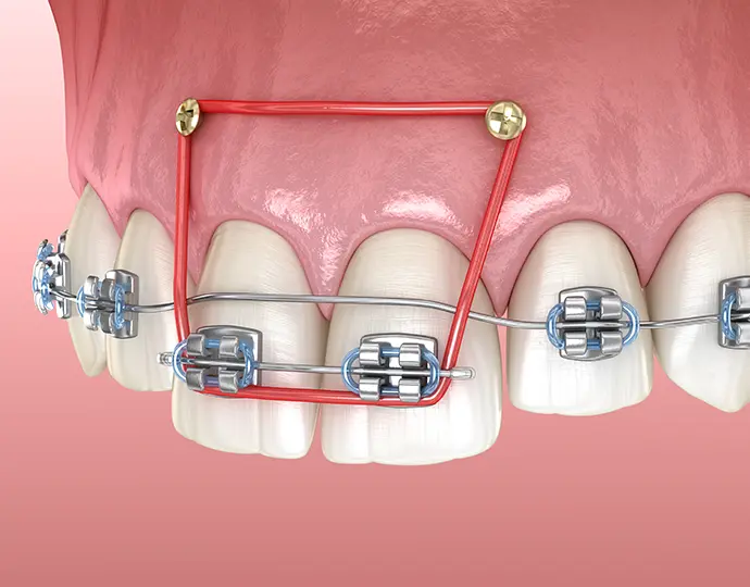 効果的に歯を移動させるインプラント矯正(アンカースクリュー)