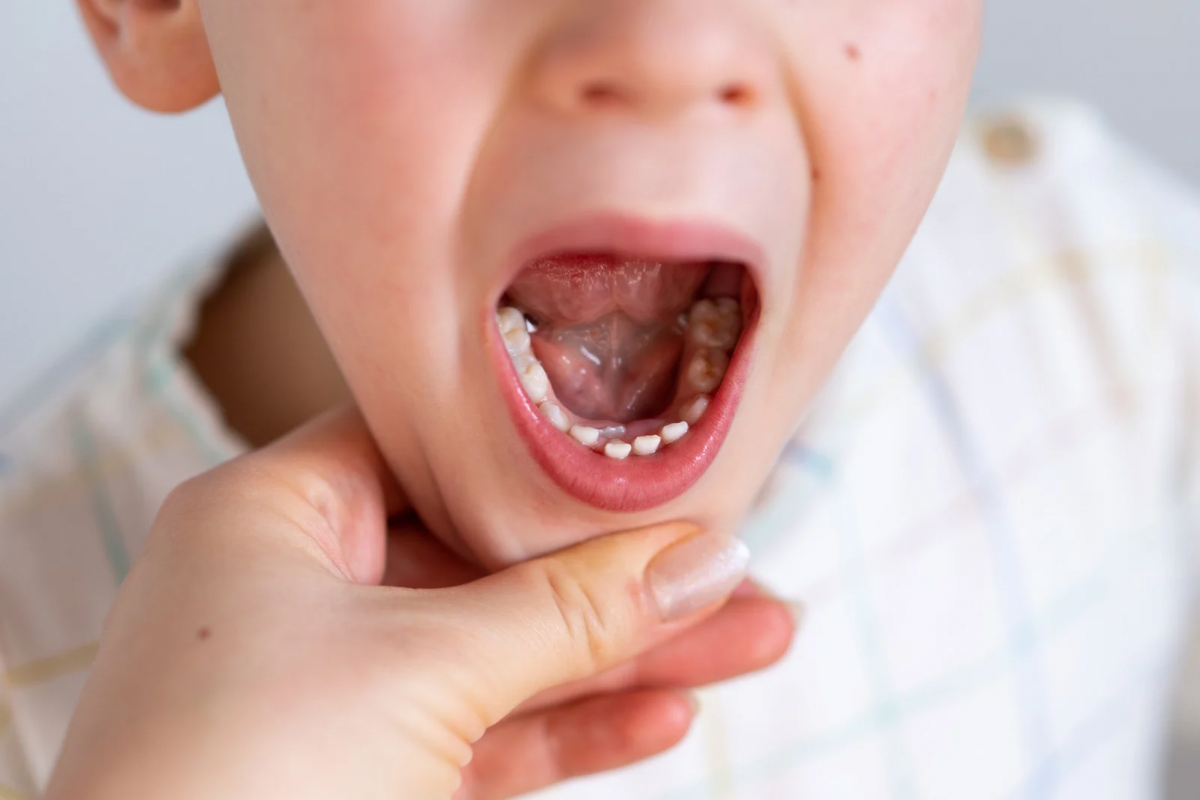 🦷ナイトガードって何？歯ぎしり・食いしばり対策に！🦷