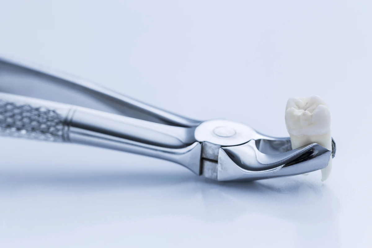 🦷抜歯後の過ごし方で差がつく！トラブルを防ぐための注意事項🦷