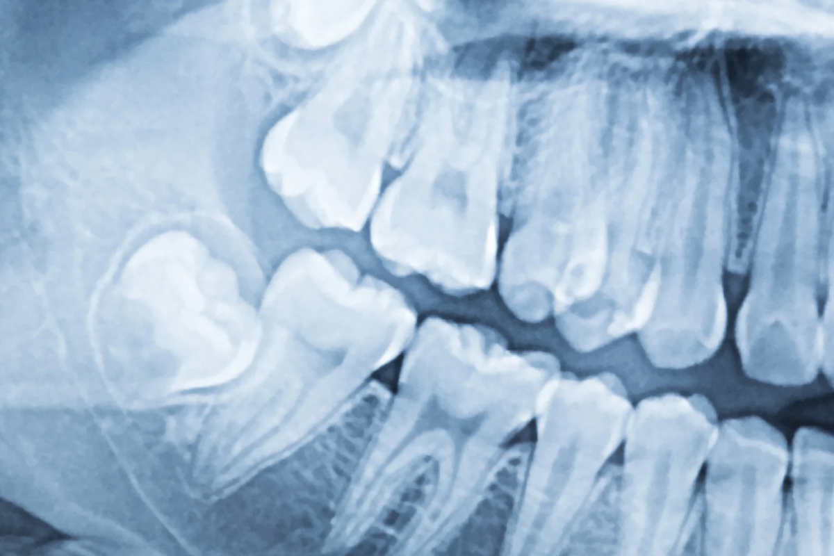 🦷その親知らず、抜いたほうがいいかも？—抜歯を検討すべきケースとは🦷