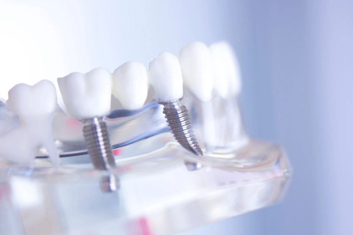 🦷インプラントとは?その仕組みやメリットデメリットについて🦷