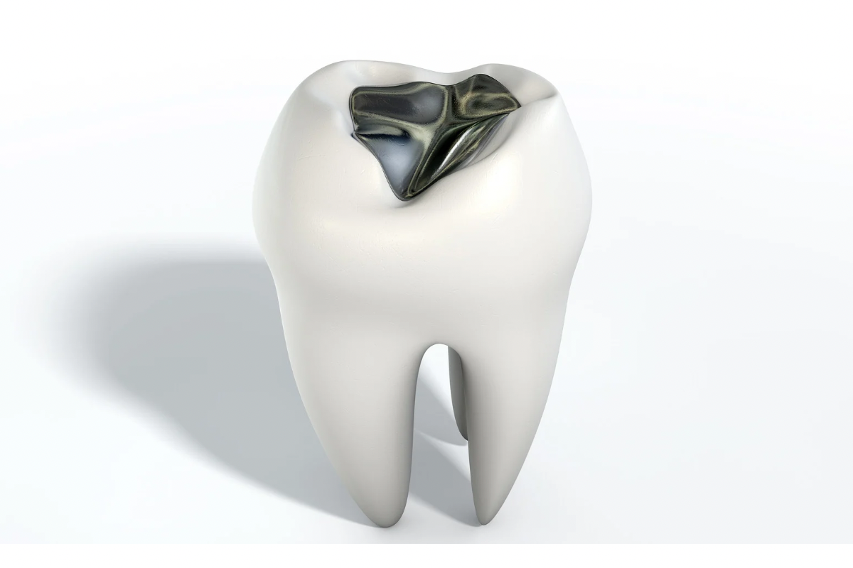 🦷銀歯ってどうなの？—保険適用の詰め物・被せ物のメリットと注意点