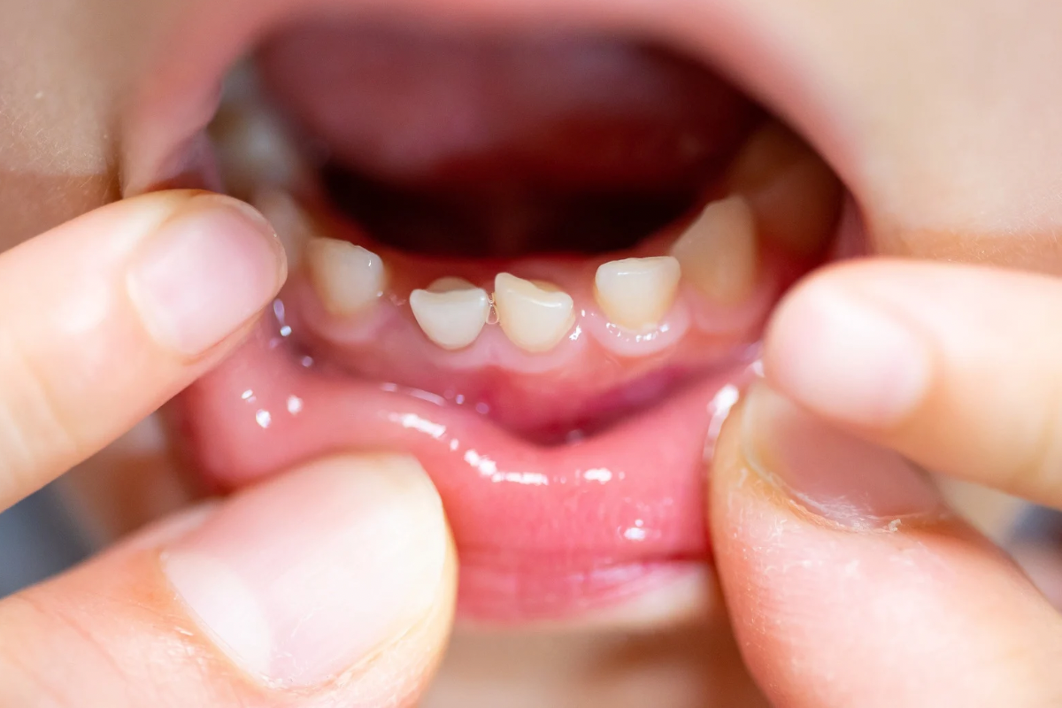 🦷乳歯の虫歯は放置NG！—永久歯や歯並びに与える影響とは？🦷