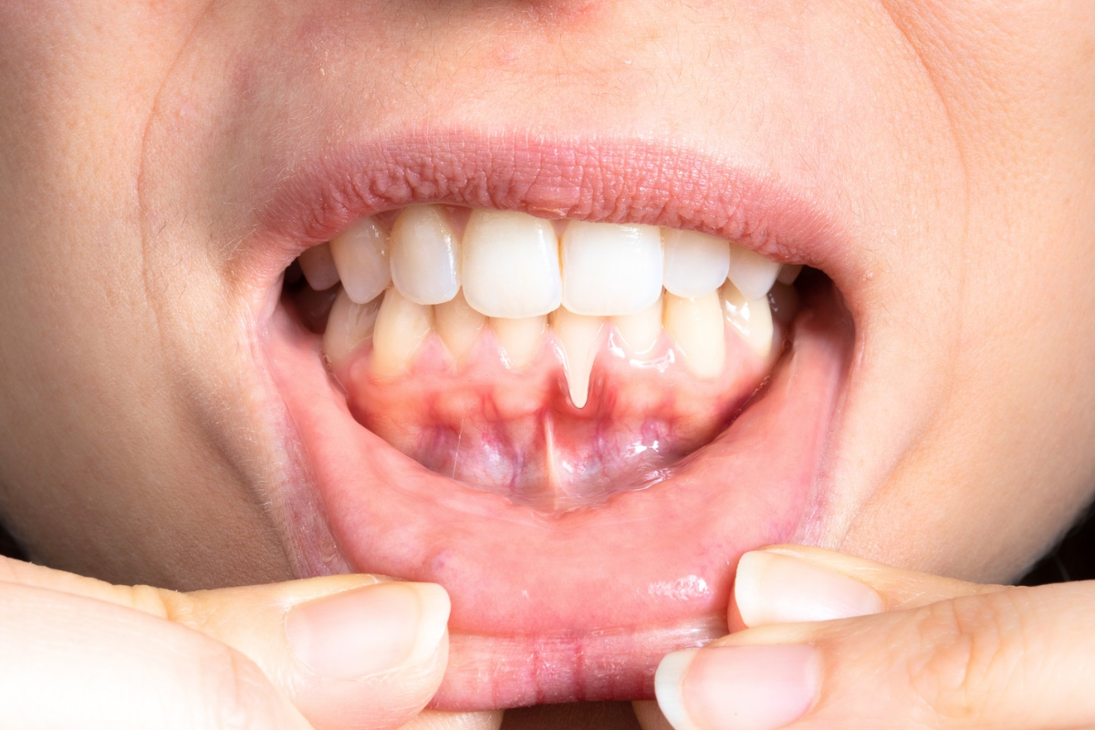 🦷ドライマウスの危険性とは？—口腔乾燥がもたらすリスクと予防法🦷