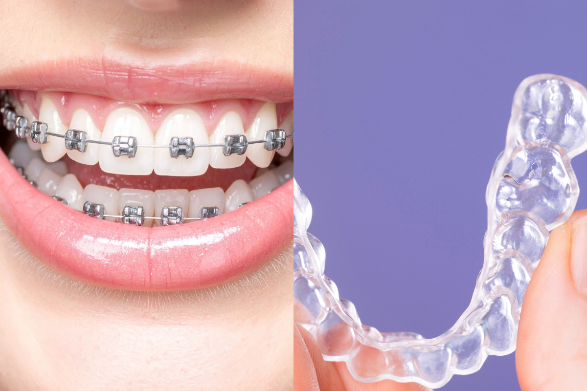 🦷見た目？効果？あなたに合うのはどっち？マウスピース矯正とワイヤー矯正の違い🦷