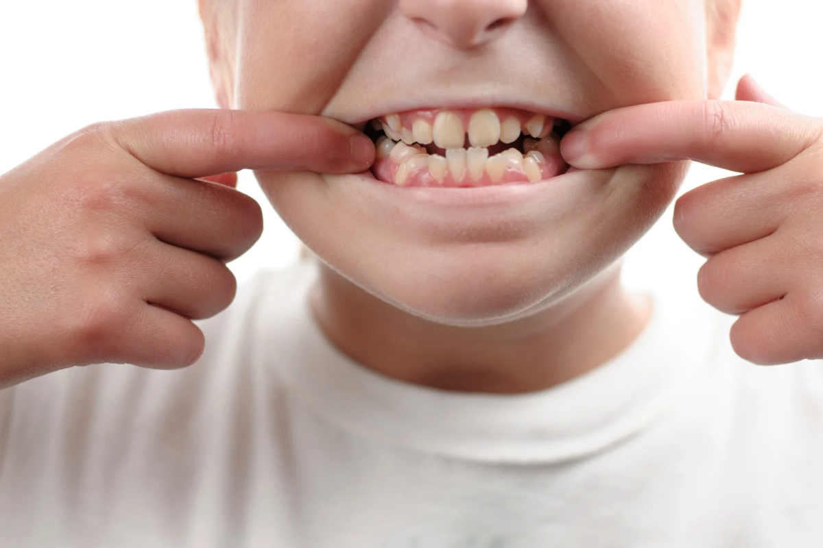 🦷その癖、歯並びを変えてしまう？—今日から見直したい“口腔悪習癖”とは🦷