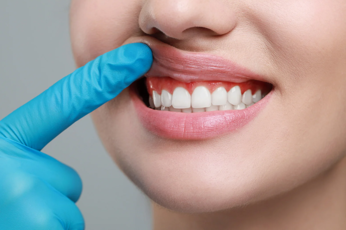 🦷歯肉炎とは？—歯周病との違いと早期ケアの重要性🦷