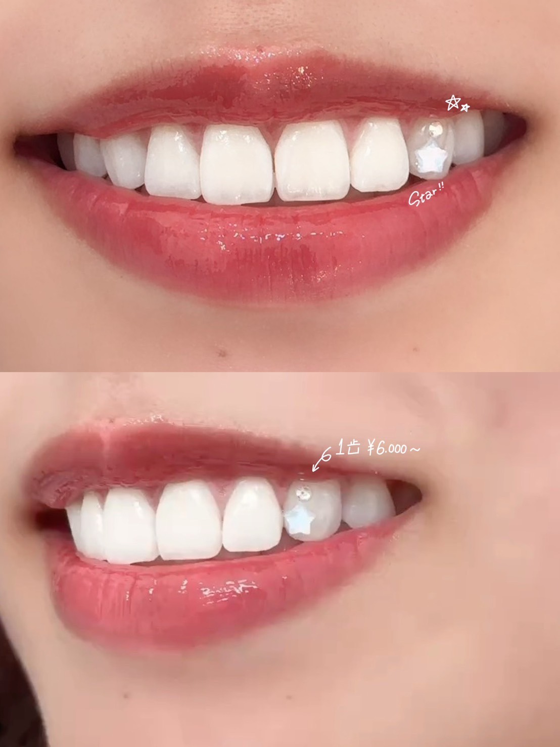 ティースジュエリー 症例画像