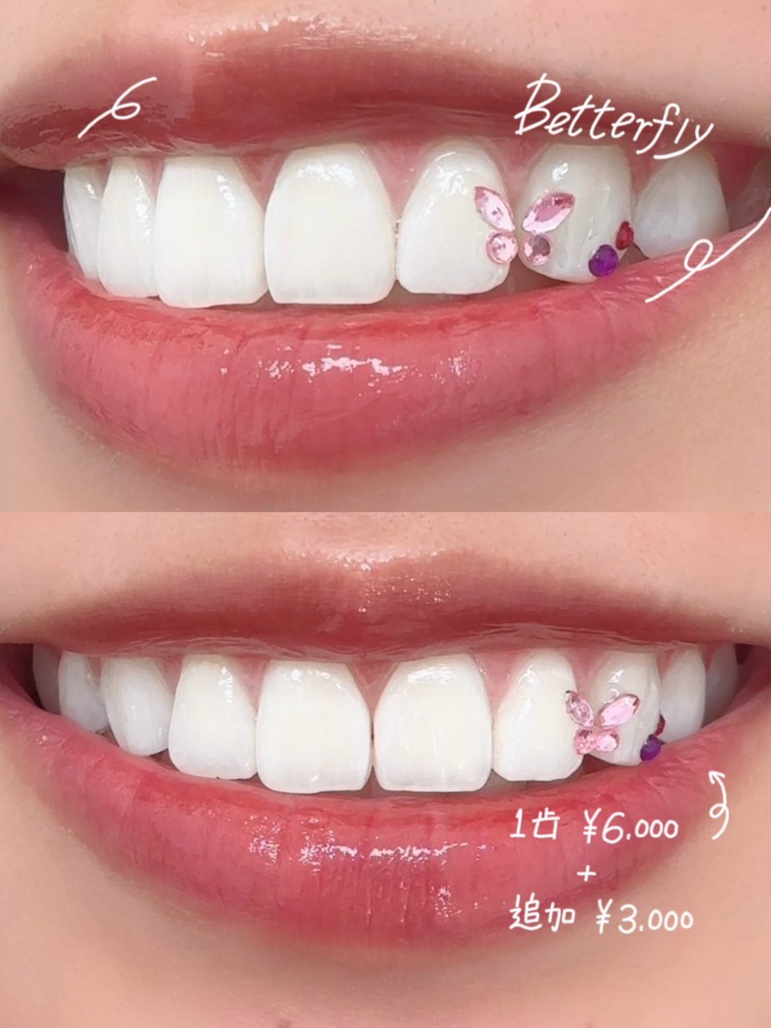 ティースジュエリー 症例画像