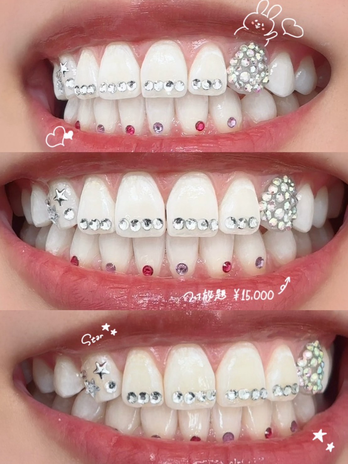 ティースジュエリー 症例画像