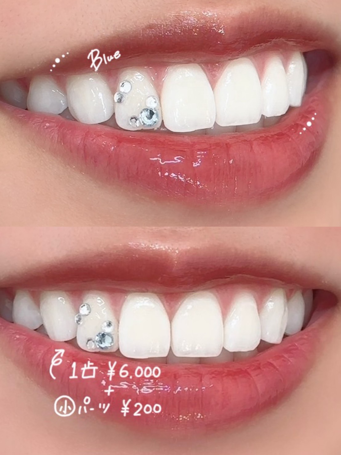 ティースジュエリー 症例画像