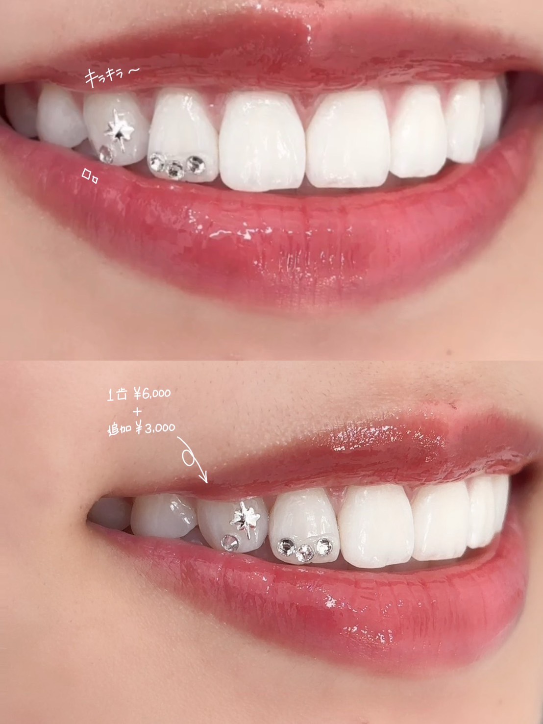 ティースジュエリー 症例画像